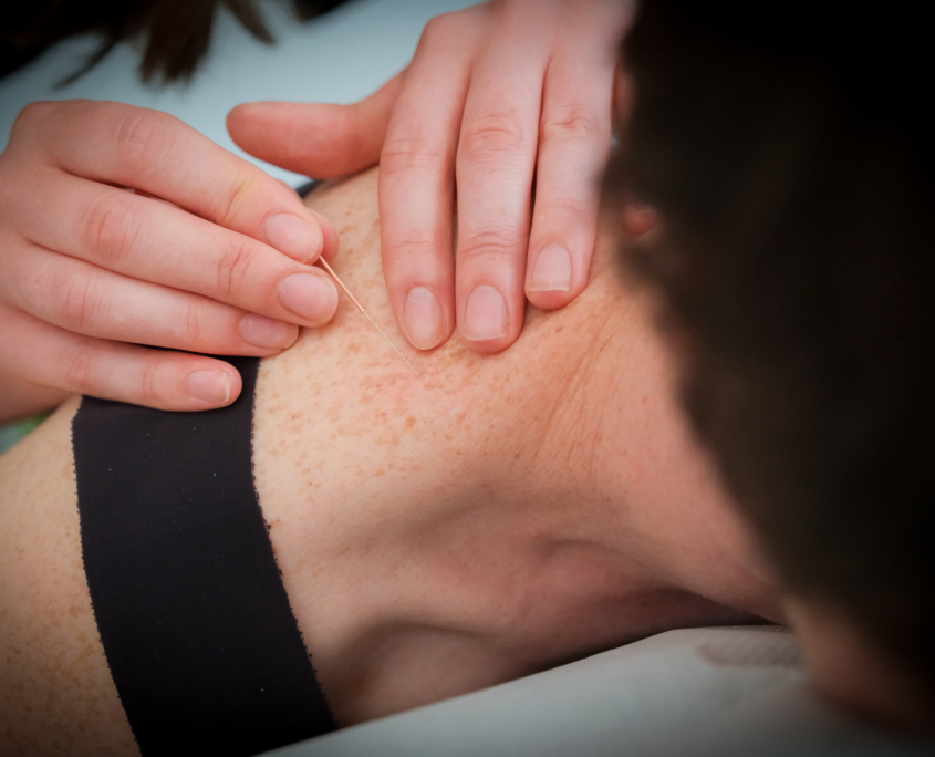 Dry Needling